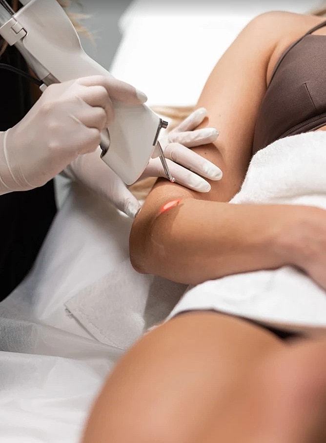 Laser treatment on a woman's arm.